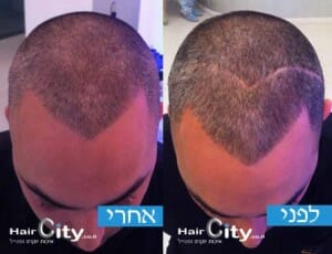 צלקת בשיער