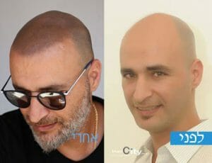 קעקוע שיער