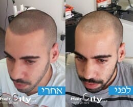 הדמיית שיער גולן