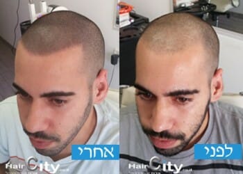 הדמיית שיער גולן