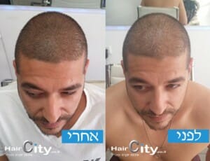 תמונות הדמיית שיער 03