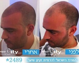 הדמיית שיער לפני ואחרי