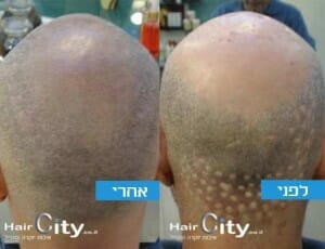 מיקרופיגמנטציה לצלקות אחרי השתלת שיער