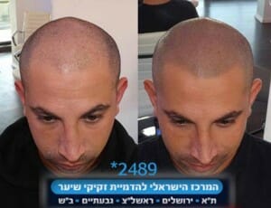 הדמיית שיער לגברים
