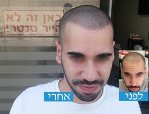 מיקרופיגמנטציה