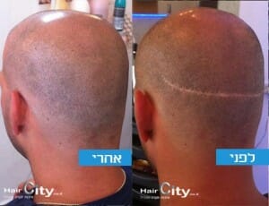 מיקרופיגמנטציה לצלקות