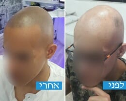 הדמיית שיער מיקרופיגמנטציה לאלופציה אראטה לפני ואחרי