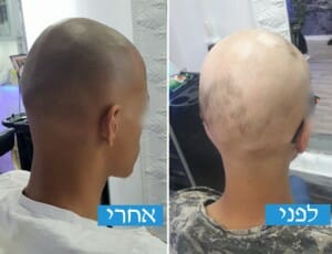זקיקי שיער